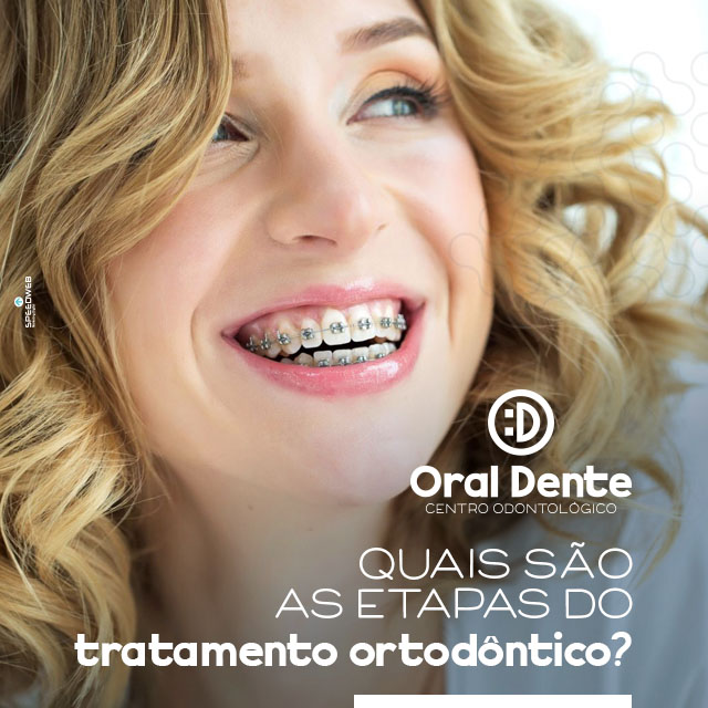 Quais são as etapas do tratamento ortodôntico? – Oral Dente
