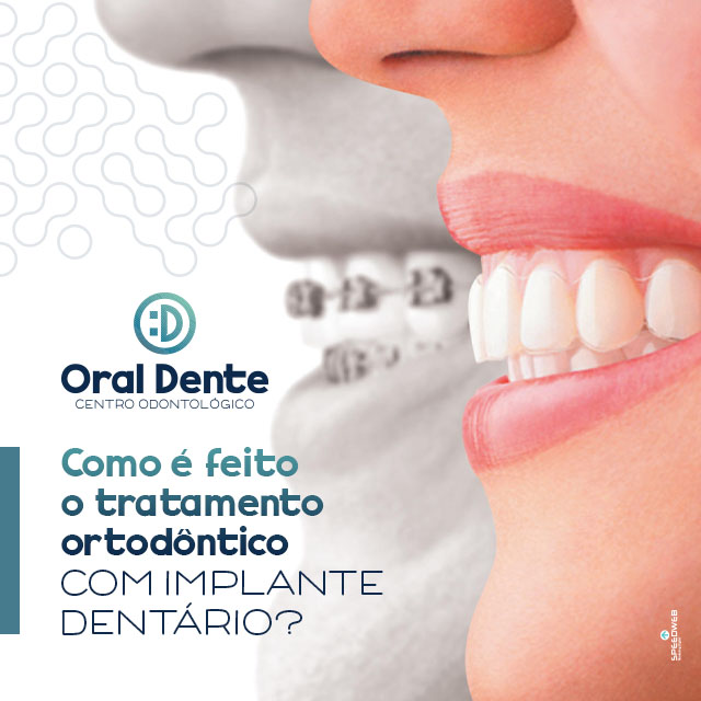 Como é feito o tratamento ortodôntico com implante dentário